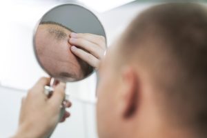 adult-male-having-balding-problems adult-male-having-balding-problems
